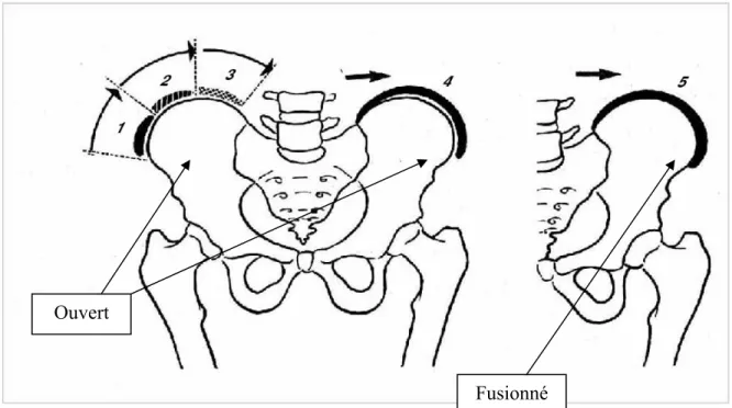 Figure 4. Le grade de Risser. Le Risser 5 correspond à l’ossification complète de la crête 