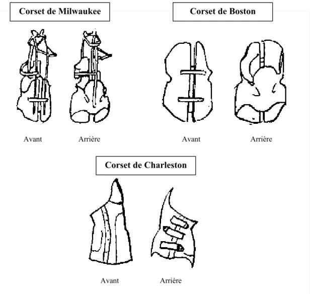 Figure 5 : Plusieurs types de corsets rigides. Vues avant et arrière (adapté de  www.scoliosis.org)  Corset de Milwaukee  Corset de Charleston  Corset de Boston AvantArrièreAvantAvantArrière Arrière