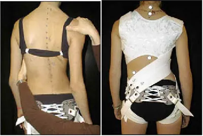 Figure 6:  Patient montrant le mouvement correcteur et  le corset SpineCor® (Image 