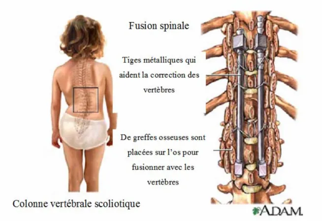 Figure 7:  La fusion spinale ( adapté de A.D.A.M; http://www.adam.com). 
