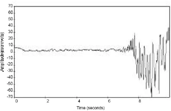 Figure 6: Illustration du « burst suppression » sur l’EEG : alternance de tracé presque plat et  d’activité paroxysmale (39) 