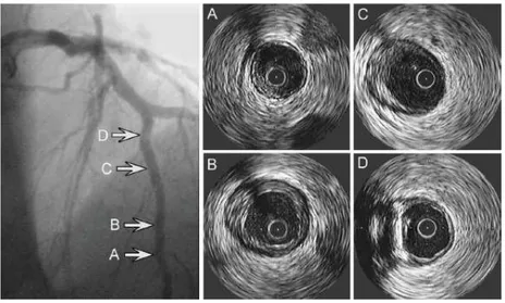 Figure 1.10 – Exemple d’une image angiographique coronarienne et images IVUS correspondantes à 4 différents sites d’un vaisseau angiographiquement normal