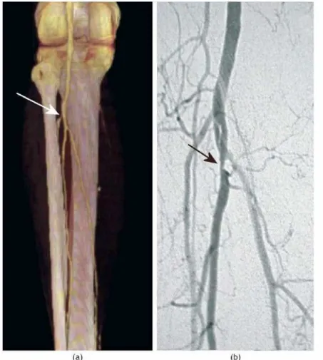 Figure 1.11 – Exemple d’images CTA (a) et DSA (b) pour des artères des membres inférieurs