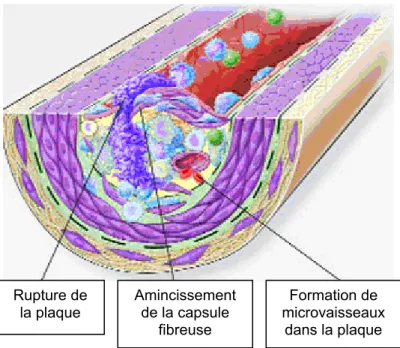 FIGURE 1.2 : Illustration d’une plaque athéromateuse rupturée. 