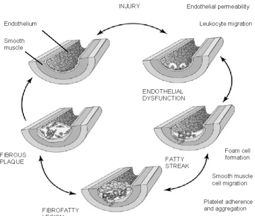 Figure 1.  Stades du développement de l’athérosclérose (adapté de Ross R, 1999). 