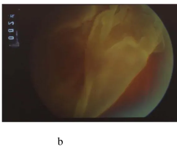 Figure  5  :  Photographies  du  fond  de  l’œil  montrant  un décollement  de  rétine avec  une  petite  déchirure  (a),  avec  de  gros  plis  rétiniens  (b)