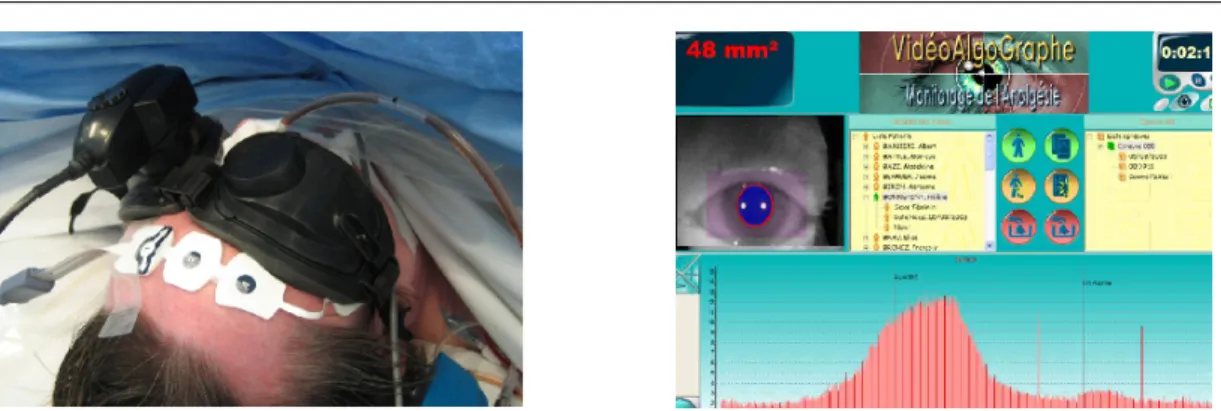 Figure 2.5 – La caméra du VAG et le logiciel associé, Synapsys [Coffy 2010]