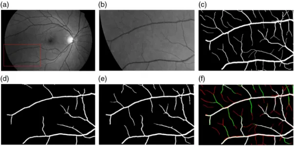 Fig. 7 Small-vessel segmentation example in healthy image from HRF datasets. (a) Grayscale input image; (b) zoomed region corresponding to inset in (a); (c) zoomed region of the manual segmentation; (d) MSLD segmentation result; (e) our segmentation result; and (f) the fusion between the manual segmentation and the proposed method segmentation result (the interpretation of each color in (f) is presented above in this section).