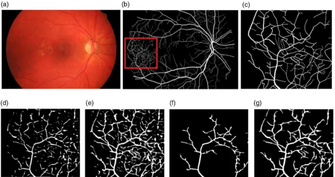 Fig. 4 Effect of the threshold and the postprocessing steps on the final segmentation result in (image 06 DR case, HRF datasets): (a) the diabetic fundus image; (b) truth segmentation image; (c)  ground-truth segmentation corresponding to the red square inset in (b); (d) and (e) the segmentation by the MSLD and the proposed algorithms, respectively; and (f) and (g) the effect of the postprocessing on the final segmentation for the MSLD approach and the proposed method, respectively.