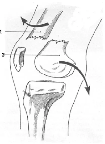 FIG 13 : Déplacement d’une fracture supra condylienne.  Source : PATEL &amp; COLL [11] 