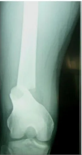 Fig. 16  Radiographie de face :fracture supra condylienne simple Type I selon la  classification de la SOFCOT 