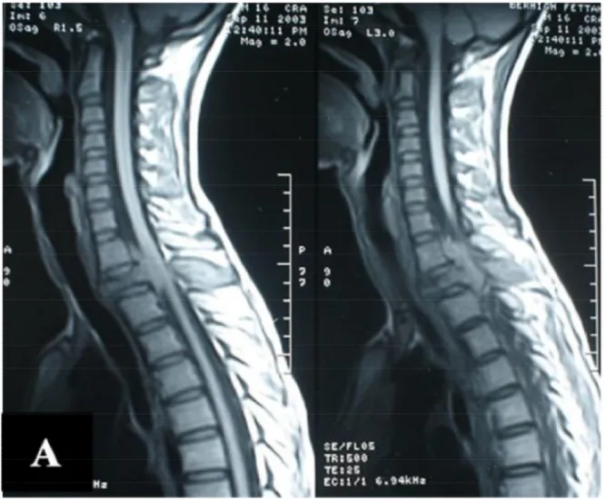 Figure 1 A : IRM de la charnière cervico-dorsale en coupe sagittale, 