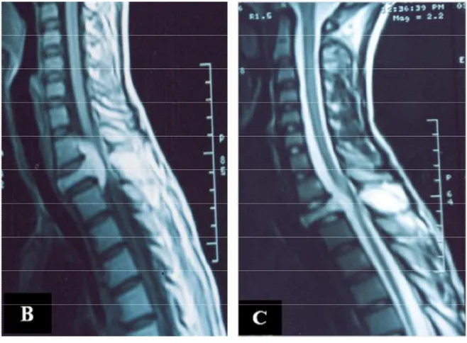 Figure 1 B et C :  IRM   du rachis cervico-dorsal du même patient, 