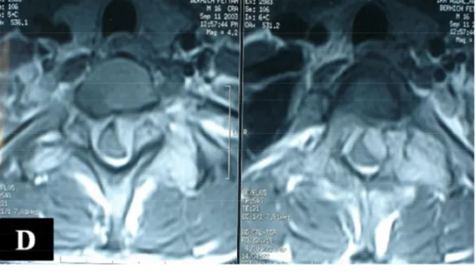 Figure  1  D  :  Coupe  axiale  d’IRM  en  séquence  pondérée  T1  avec 