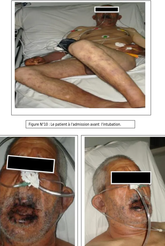 Figure N°10 : Le patient à l'admission avant  l'intubation. 