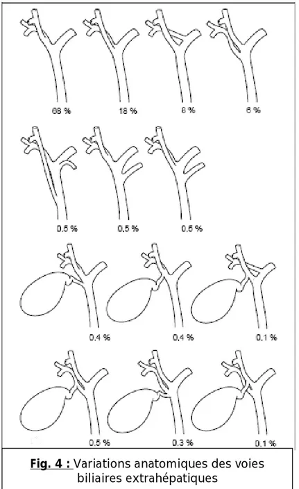 Fig. 4 : Variations anatomiques des voies  biliaires extrahépatiques 