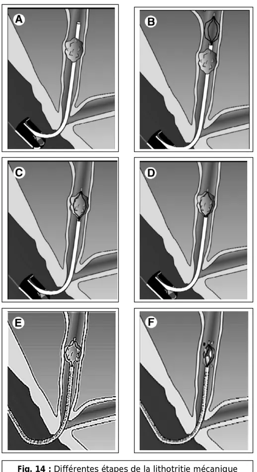 Fig. 14 : Différentes étapes de la lithotritie mécanique 