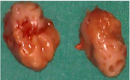 Figure 11  [5]  : Amygdalectomie bilatérale 