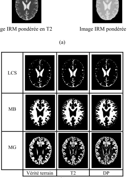 Figure 5.3 : (a) Images IRM en pondérations T2 et DP (coupe 94) illustrants la fusion