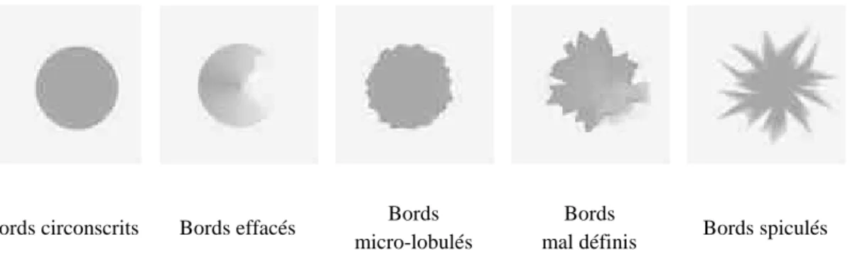 Figure 1.3 : Les différents types de bords de masses  1.1.4.2- Les microcalcifications 