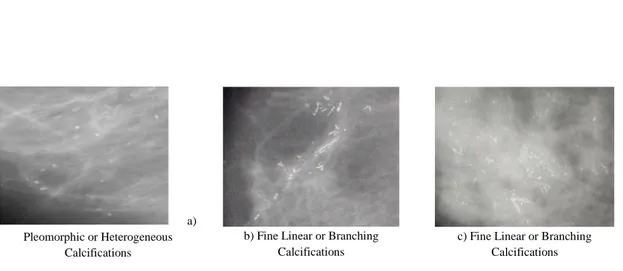 Figure 1.5 : Exemple de calcifications malignes  