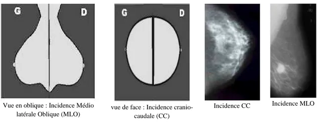 Figure 1.7 : Incidence cranio-caudale et l’incidence Médio latérale oblique pour  l’acquisition d’un mammogramme 