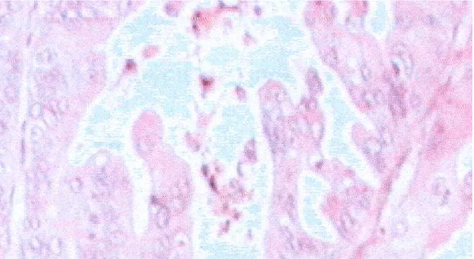 Figure n°5:  Tumeur Borderline type mucineux HES*10, papilles à axes conjonctivo- conjonctivo-vasculaire  grêle,  sans    infiltration  du  chorion(image  tirée  du  laboratoire  d'anatomopathologie CHU Hassan II Fès) 