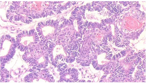 Figure n °7:   Adénocarcinome endométrioide de l'ovaire HES*250                       Prolifération carcinomateuse faite de tubes basophiles                          irréguliers avec  focalement des signes d'inflexion  