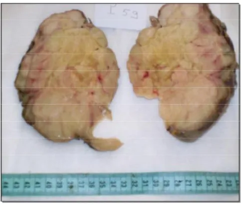Figure 6 : Tumeur rétropéritonéale, la pièce de résection tumorale adressée fixée 