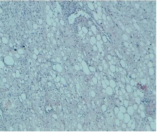 Figure 9 : Liposarcome bien différencié sclérosant : Zones d'adipocytes matures 