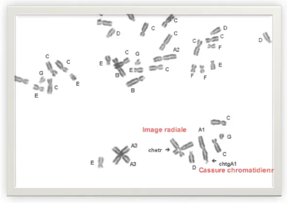 Figure n°12: caryotype dans l'AF (90) 