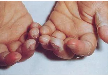 Figure 6 : Desquamation des mains qui se fait en lambeaux et débute au pourtour  des ongles [11]