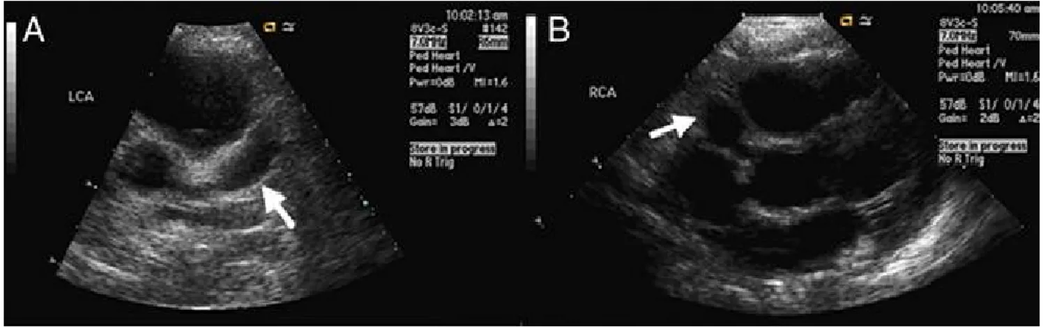 Figure 22 : Echocardiographie trans-thoracique chez un enfant de 2 ans, montrant  un anévrisme de l’artère coronaire gauche (A, flèche) et de l’artère coronaire droite  (B,  flèche)