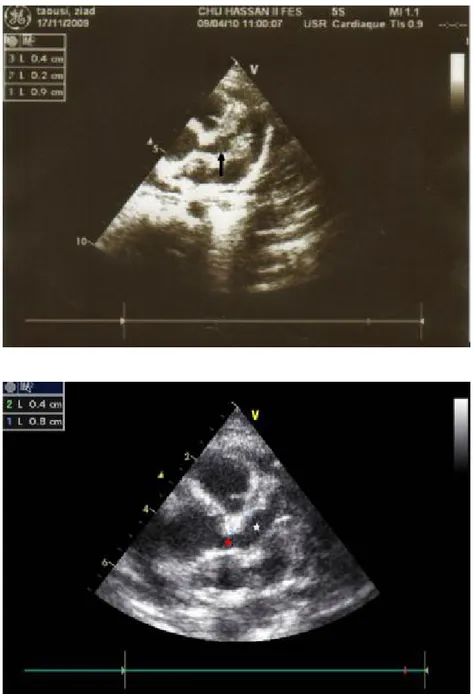 Figure 23 : Echocardiographie 2D montrant deux anévrismes de la coronaire gauche  dont l’un est de 4mm (étoile rouge) et l’autre est géant mesurant 9mm (flèche)  sur  une échographie, et 8mm (étoile blanche) sur une deuxième échographie (Service de  Pédiat