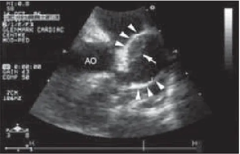 Figure 25 : Echocardiographie 2D montrant un anévrisme de grande taille au niveau  de  la  partie  proximale  de  l’artère  inter-ventriculaire  antérieure  (têtes  de  flèche)  mesurant 18 mm, avec la présence de thrombus (flèche)