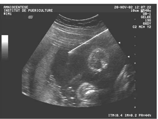 Fig. 1. Amniocentèse. L’aiguille est visualisée dans la cavité amniotique.  1.1.2 Cas particuliers : 