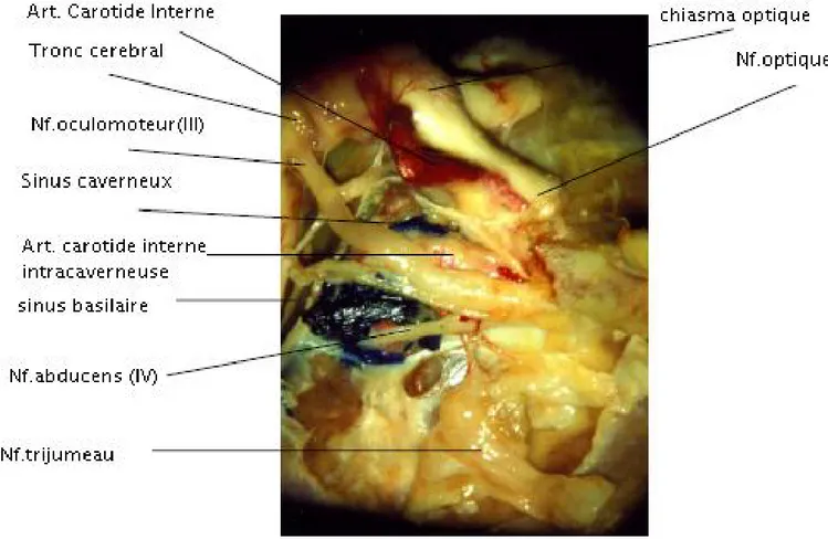 Figure  9: Dissection de la loge caverneuse droite en vue latérale montrant l’artère  carotide intracaverneuse et les éléments nerveux de la loge [17] 