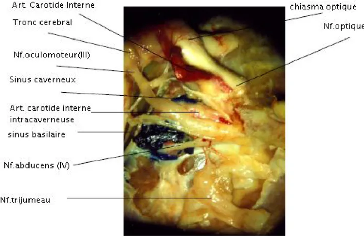 Figure  9: Dissection de la loge caverneuse droite en vue latérale montrant l’artère  carotide intracaverneuse et les éléments nerveux de la loge [17] 