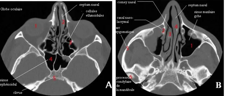 Figure 11 : Coupes axiales du massif facial. A passant par les cellules ethmoïdales et  les sinus sphénoïdaux