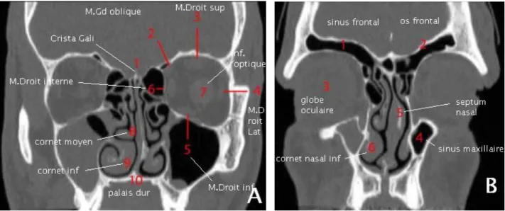 Figure 12 : Reconstruction coronal la coupe B étant plus postérieure que la coupe A  [21] 