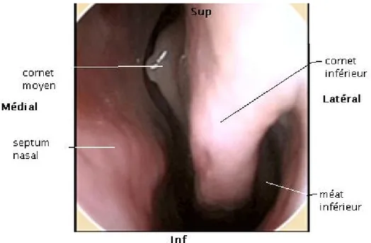 Figure 17: Endoscopie nasale montrant le cornet inférieur et son méat [30] 