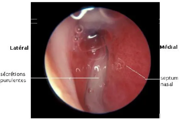 Figure 22: écoulement nasal purulent du côté droit [42]  1.  Résultats de l’examen ophtalmologique : 