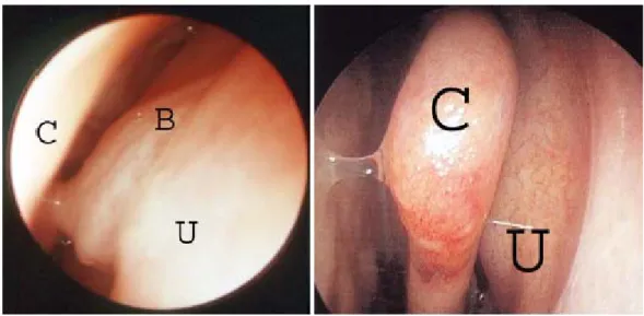 Figure 4 : endoscopie de la fosse nasale gauche et de son méat moyen. C =  cornet moyen ; U = unciforme ; B = bulle