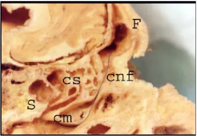 Figure 10 : rapports du canal naso-frontal (cnf). F. sinus frontal – cm et  cs. Cornet moyen et supérieur – S