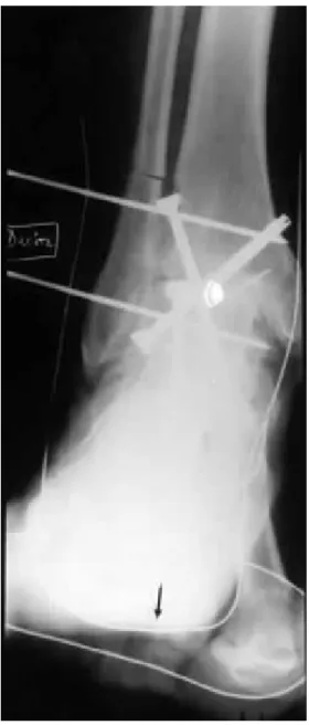 Fig. 2. - Double cerclage per-opératoire. La verticalisation du 1er métatarsien  entraîne une surcharge sous la 1ère tête en dépit d’une bonne orientation de 