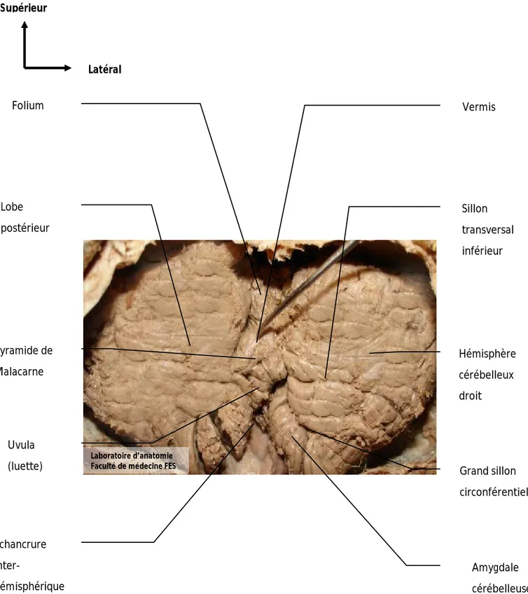 Figure 5 : vue postérieure de fosse cérébrale postérieure (FCP) montrant le cervelet. 