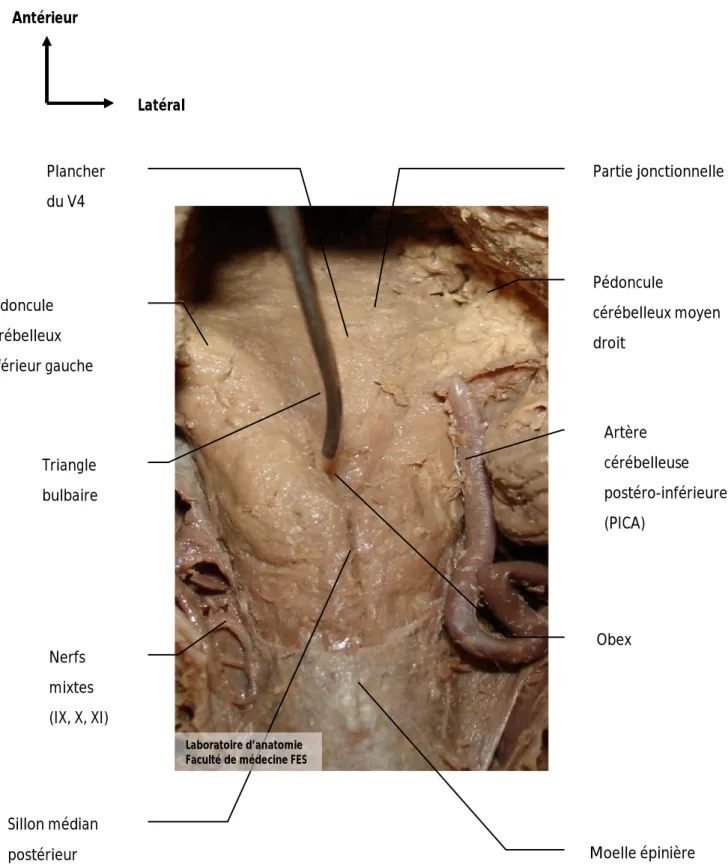 Figure 6 : vue postérieure de la fosse cérébrale postérieure montrant le triangle 