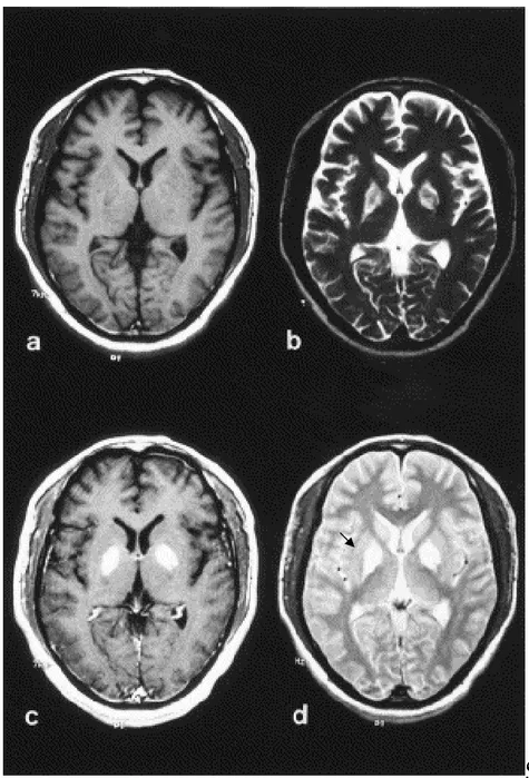 Figure 3. Images de l”IRM observées le 9 ème jour après 