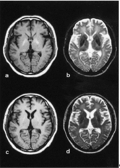 Figure 5. Des images T1 et T2   à deux mois et 5 mois après intoxication au CO [24] 