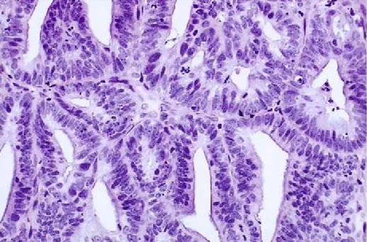 Fig. 19 : adénocarcinome bien-différencié. Les glandes d’aspect cribriforme avec  disparition du stroma  Il s'agit du modèle le plus couramment observés dans un 